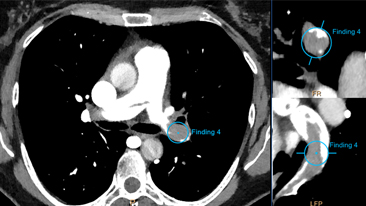 pulmonary image